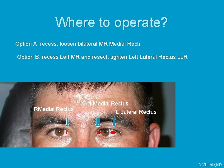 Where to operate? Option A: recess, loosen bilateral MR Medial Recti. Option B: recess