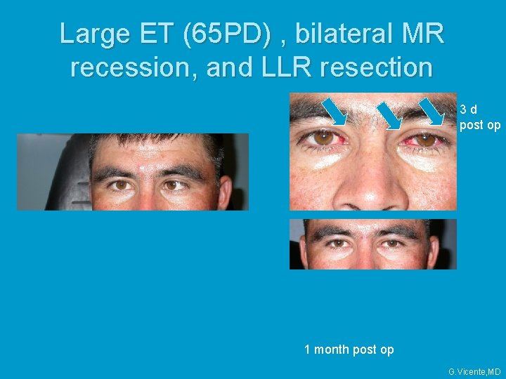 Large ET (65 PD) , bilateral MR recession, and LLR resection 3 d post Large ET (65 PD) , bilateral MR recession, and LLR resection 3 d post