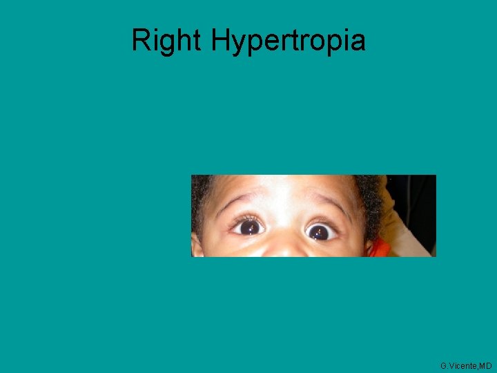 Right Hypertropia G. Vicente, MD 