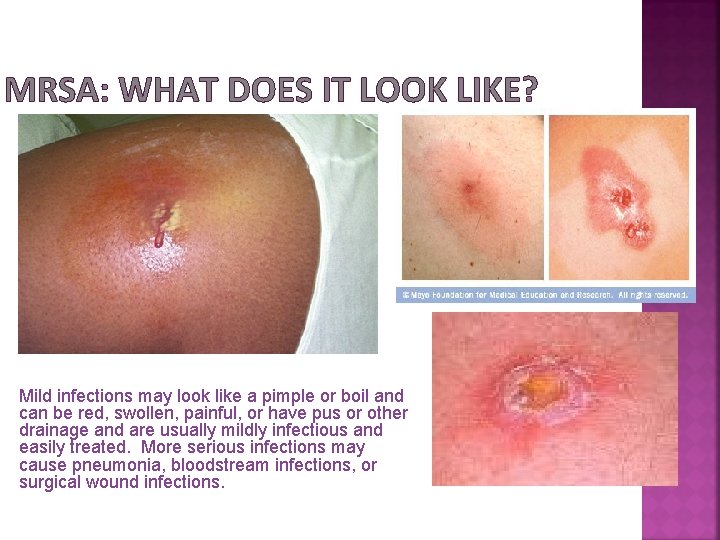 MRSA: WHAT DOES IT LOOK LIKE? Mild infections may look like a pimple or