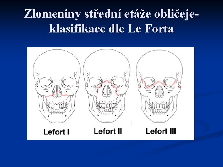 Zlomeniny střední etáže obličejeklasifikace dle Le Forta 