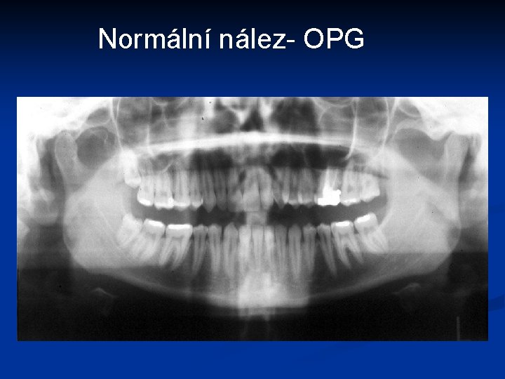 Normální nález- OPG 