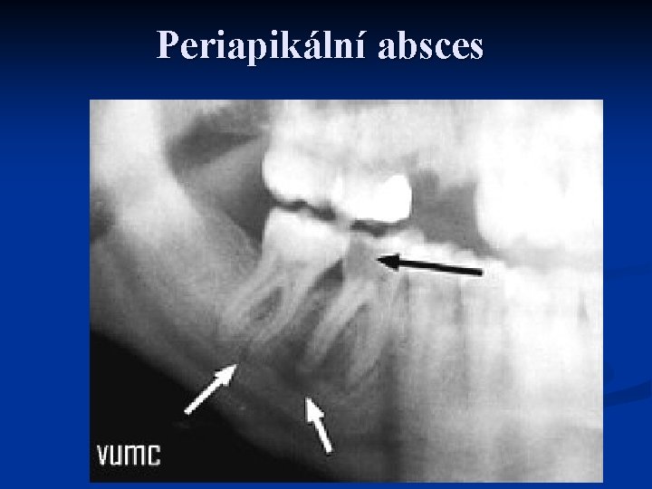 Periapikální absces 