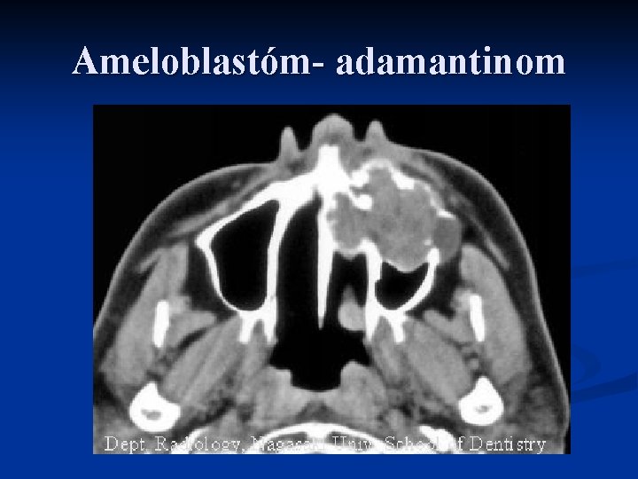 Ameloblastóm- adamantinom 