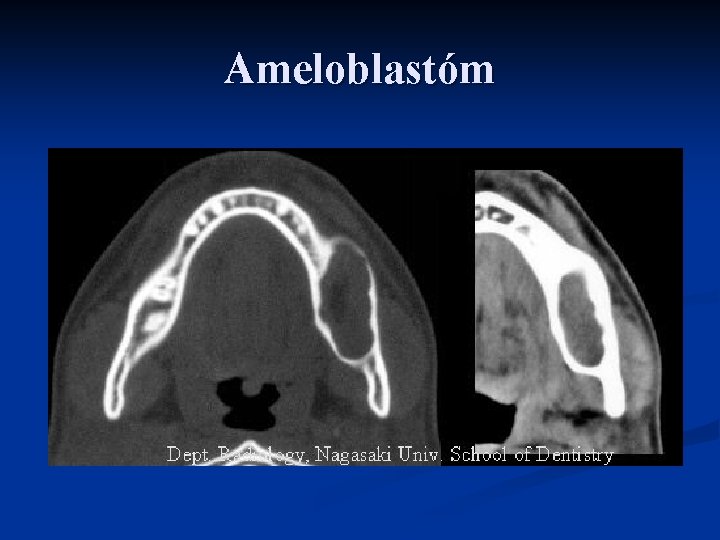 Ameloblastóm 