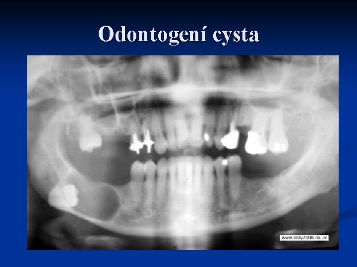 Odontogení cysta 