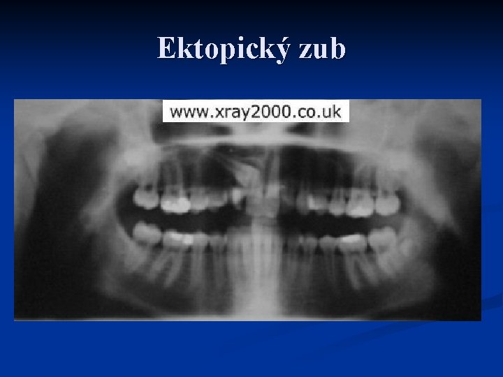 Ektopický zub 