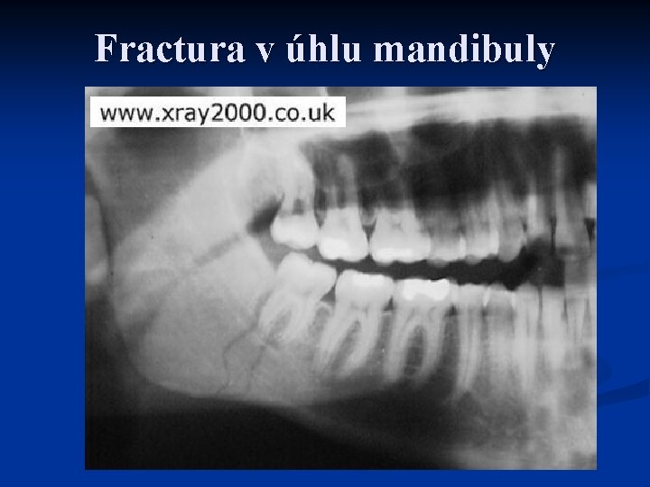 Fractura v úhlu mandibuly 