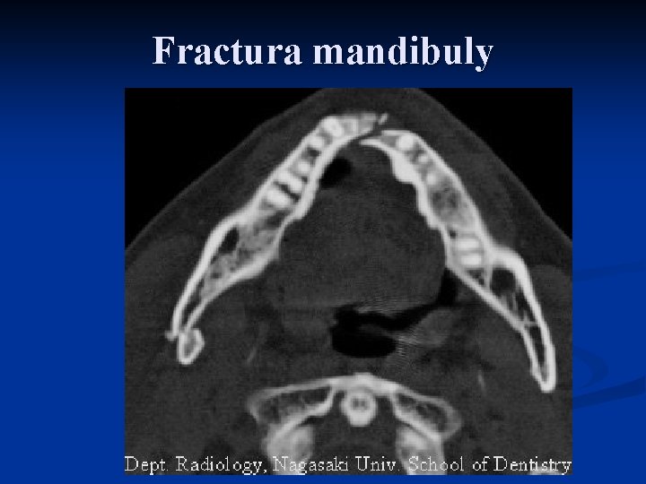 Fractura mandibuly 
