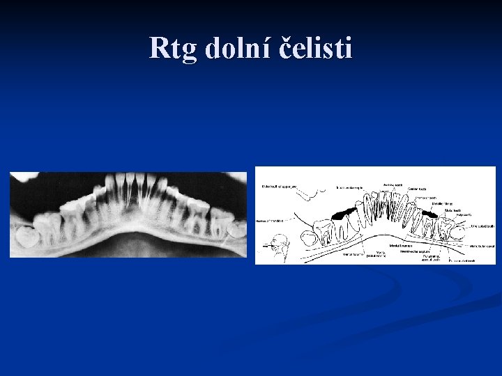 Rtg dolní čelisti 