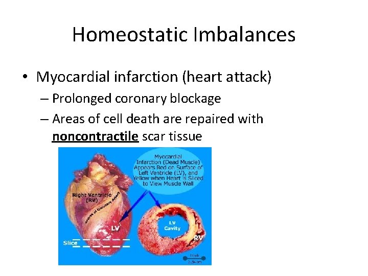 Homeostatic Imbalances • Myocardial infarction (heart attack) – Prolonged coronary blockage – Areas of