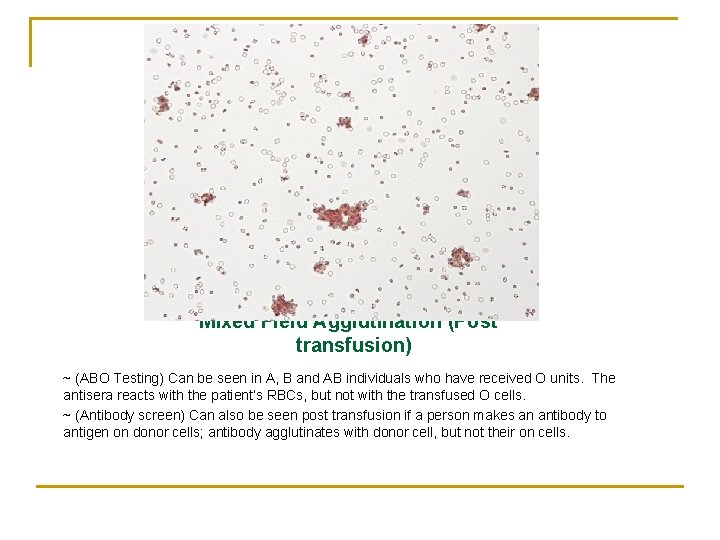 Mixed Field Agglutination (Post transfusion) ~ (ABO Testing) Can be seen in A, B