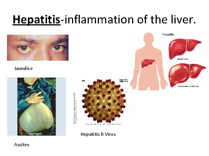 Hepatitis-inflammation of the liver. Jaundice Hepatitis B Virus Ascites 