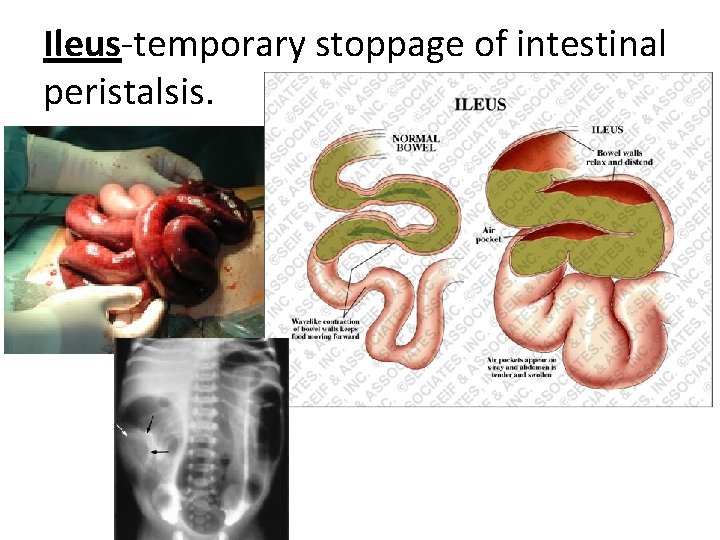 Ileus-temporary stoppage of intestinal peristalsis. 