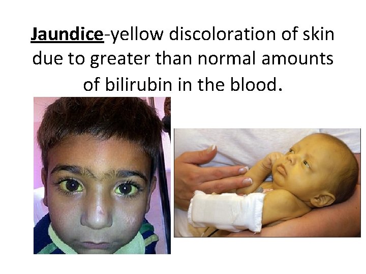 Jaundice-yellow discoloration of skin due to greater than normal amounts of bilirubin in the