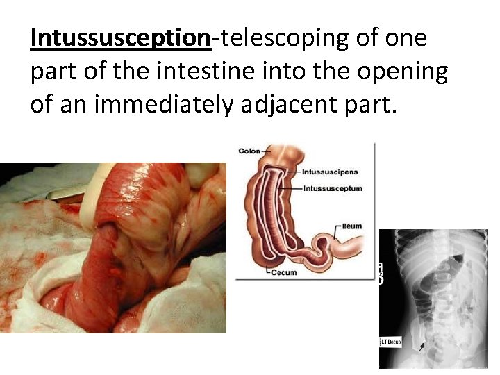 Intussusception-telescoping of one part of the intestine into the opening of an immediately adjacent