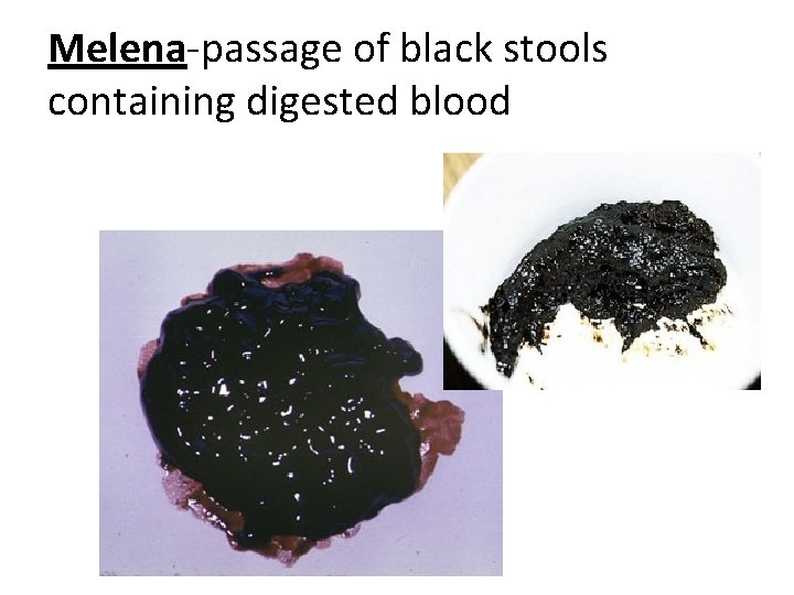 Melena-passage of black stools containing digested blood 