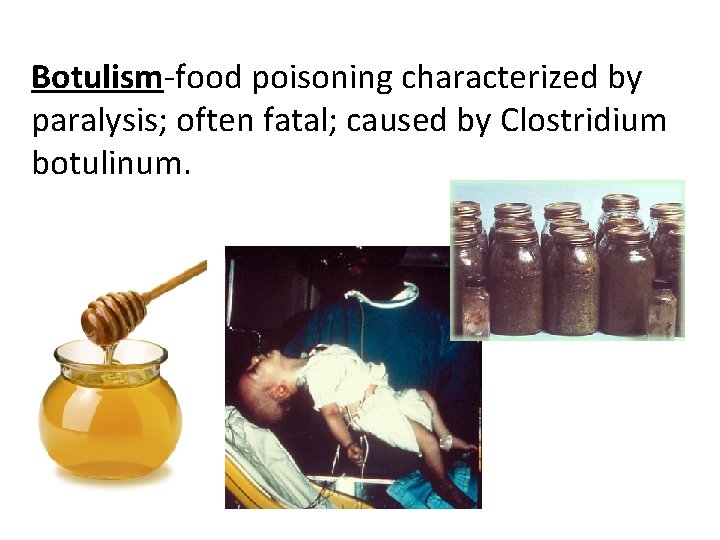 Botulism-food poisoning characterized by paralysis; often fatal; caused by Clostridium botulinum. 