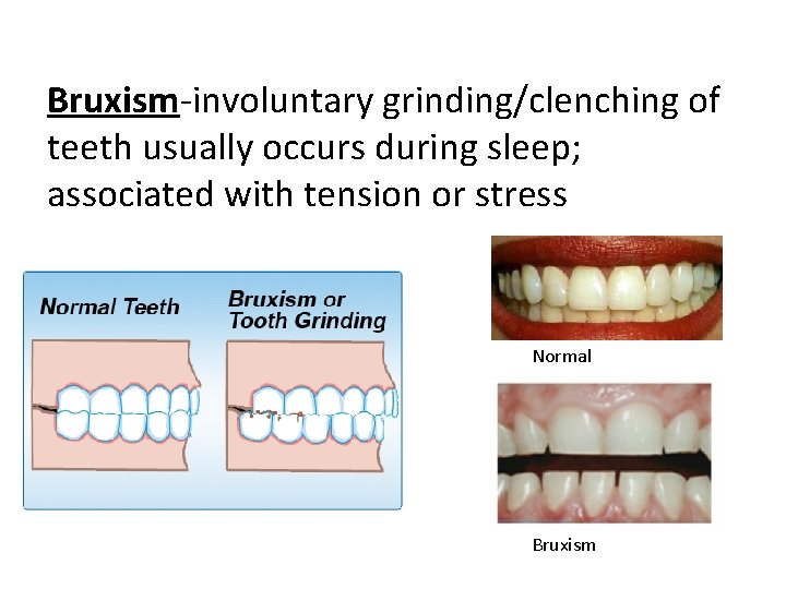 Bruxism-involuntary grinding/clenching of teeth usually occurs during sleep; associated with tension or stress Normal