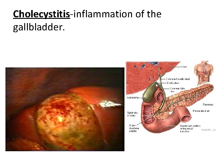 Cholecystitis-inflammation of the gallbladder. 