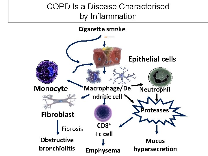 COPD Is a Disease Characterised by Inflammation Cigarette smoke Epithelial cells Monocyte Macrophage/De ndritic