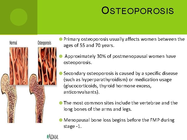 O STEOPOROSIS Primary osteoporosis usually affects women between the ages of 55 and 70