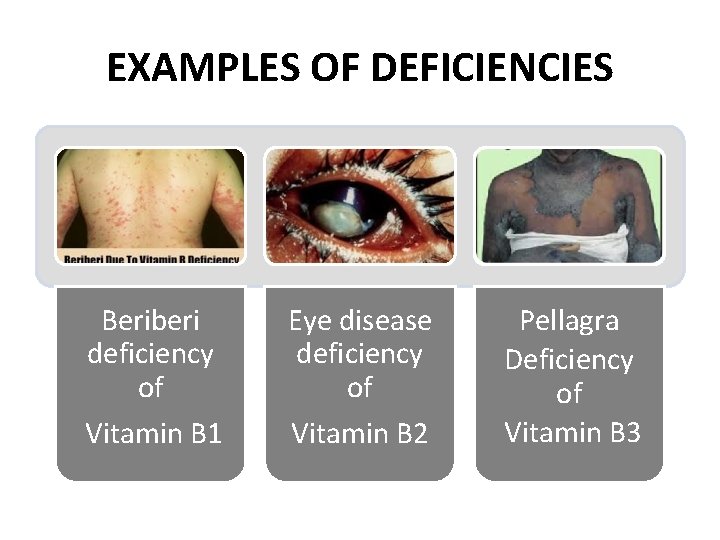 EXAMPLES OF DEFICIENCIES Beriberi deficiency of Vitamin B 1 Eye disease deficiency of Vitamin