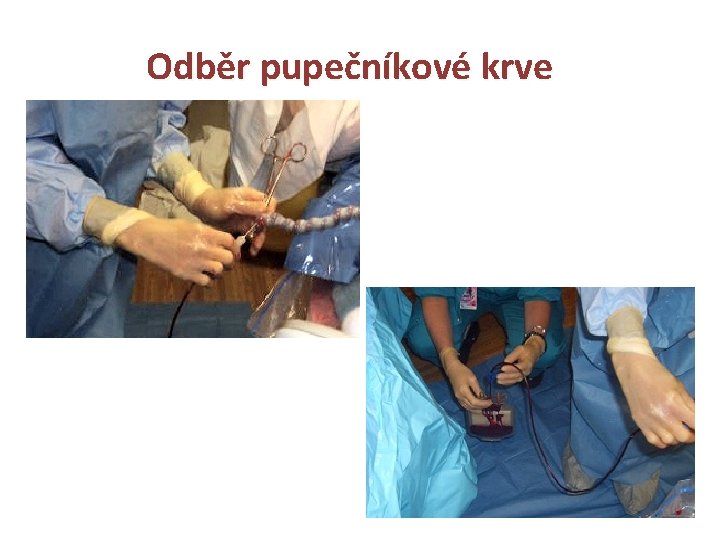 Odběr pupečníkové krve 