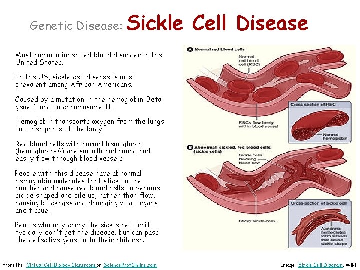 Genetic Disease: Sickle Cell Disease Most common inherited blood disorder in the United States.