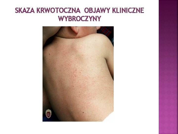 SKAZA KRWOTOCZNA OBJAWY KLINICZNE WYBROCZYNY 