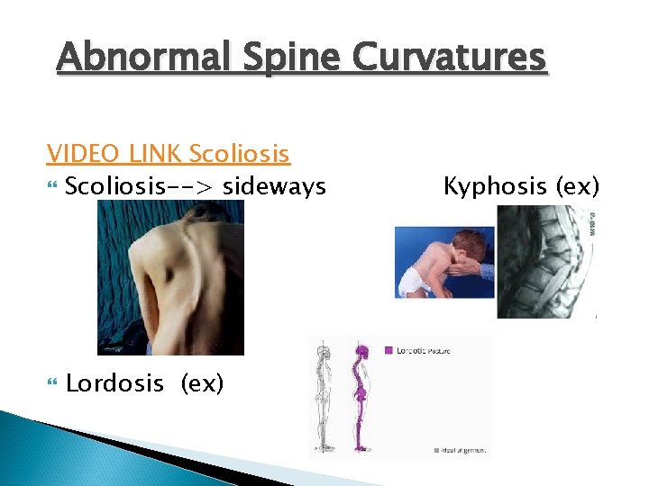 Abnormal Spine Curvatures VIDEO LINK Scoliosis--> sideways Lordosis (ex) Kyphosis (ex) 