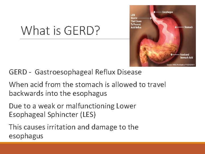 What is GERD? GERD - Gastroesophageal Reflux Disease When acid from the stomach is