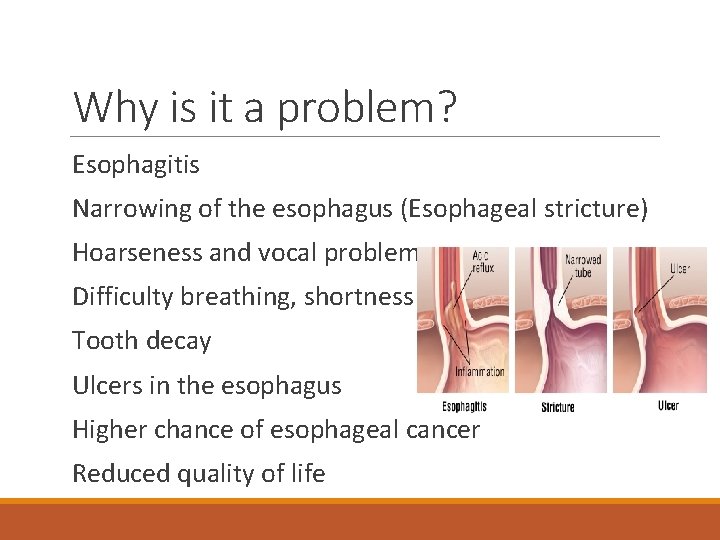 Why is it a problem? Esophagitis Narrowing of the esophagus (Esophageal stricture) Hoarseness and