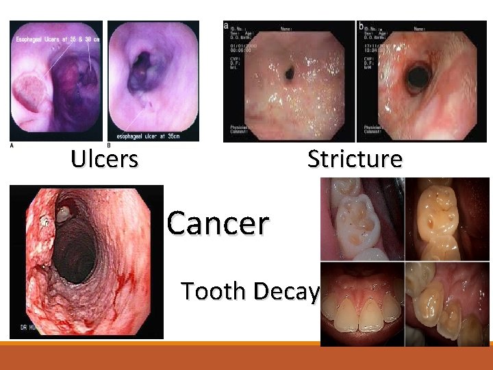 Ulcers Stricture Cancer Tooth Decay 