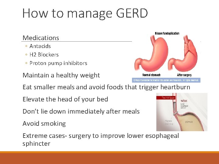 How to manage GERD Medications ◦ Antacids ◦ H 2 Blockers ◦ Proton pump