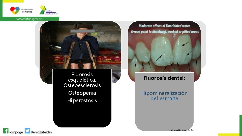 Fluorosis esquelética: Osteoesclerosis Osteopenia Hiperostosis Fluorosis dental: Hipomineralización del esmalte Instituto Nacional de Salud