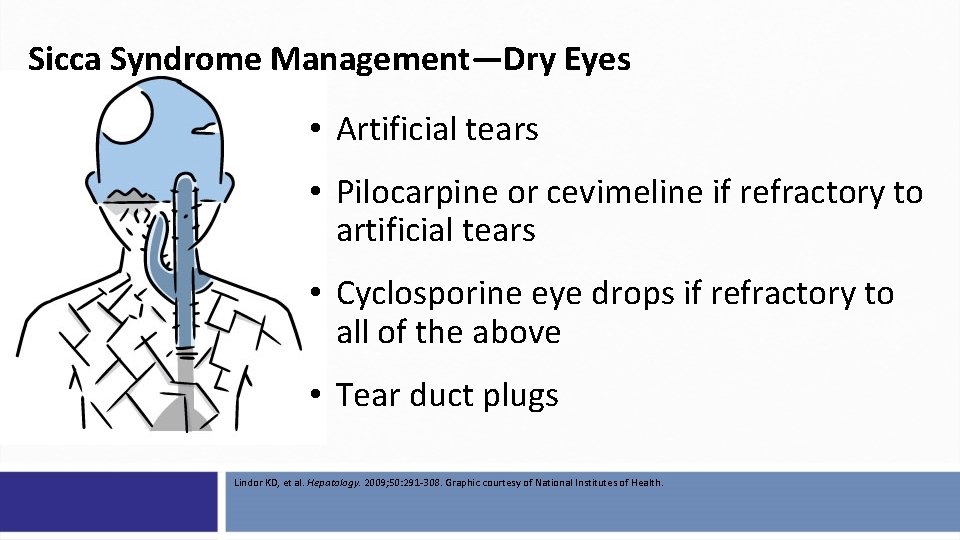 Sicca Syndrome Management—Dry Eyes • Artificial tears • Pilocarpine or cevimeline if refractory to