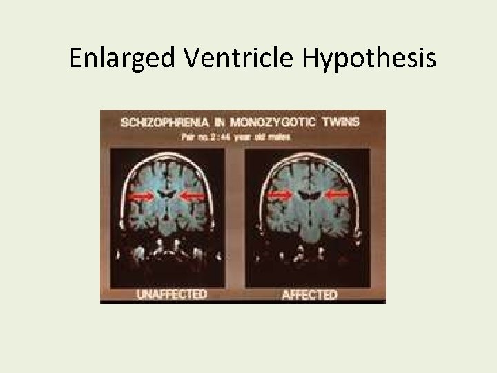 Enlarged Ventricle Hypothesis 