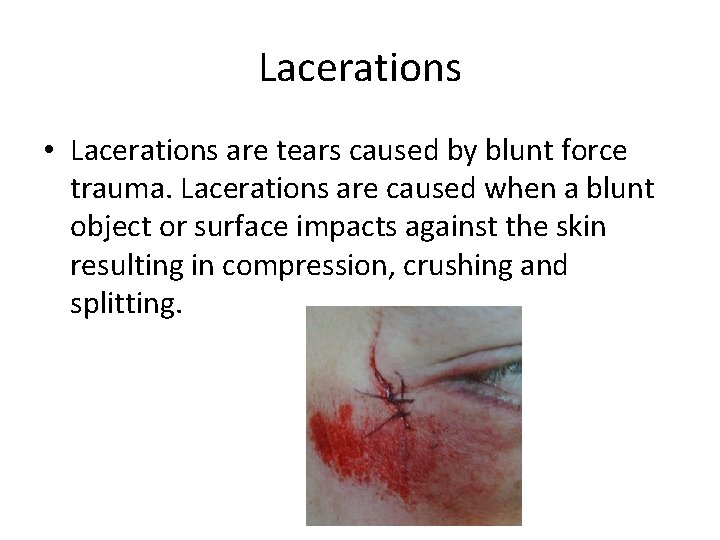 Lacerations • Lacerations are tears caused by blunt force trauma. Lacerations are caused when