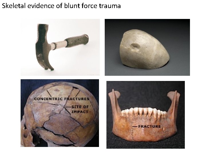 Skeletal evidence of blunt force trauma 