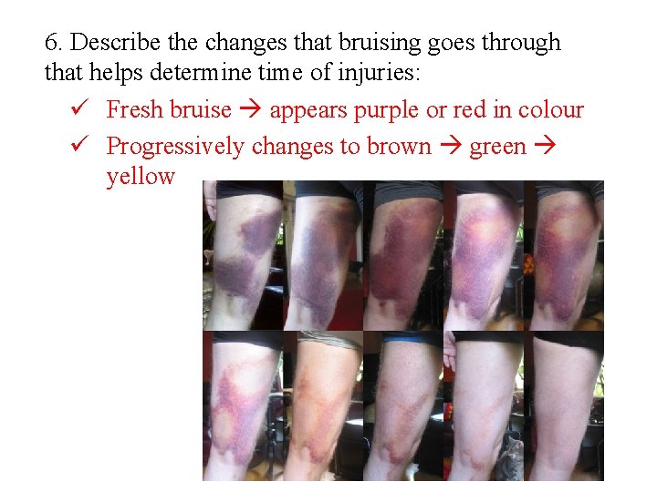 6. Describe the changes that bruising goes through that helps determine time of injuries: