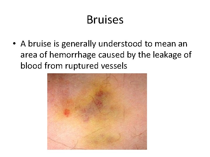 Bruises • A bruise is generally understood to mean an area of hemorrhage caused