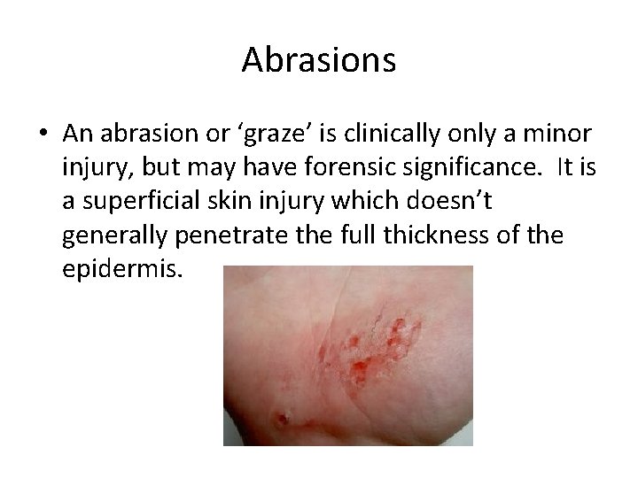 Abrasions • An abrasion or ‘graze’ is clinically only a minor injury, but may