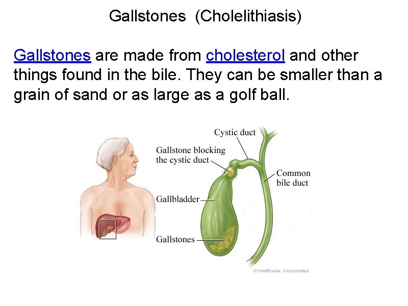 Gallstones (Cholelithiasis) Gallstones are made from cholesterol and other things found in the bile.