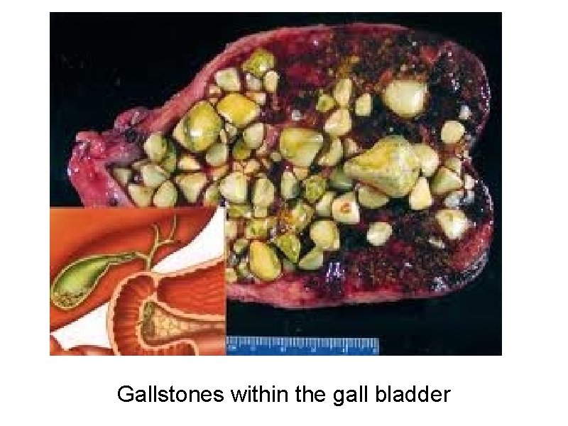 Gallstones within the gall bladder 