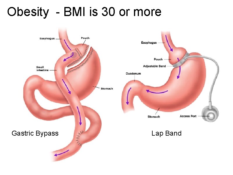 Obesity - BMI is 30 or more Gastric Bypass Lap Band 