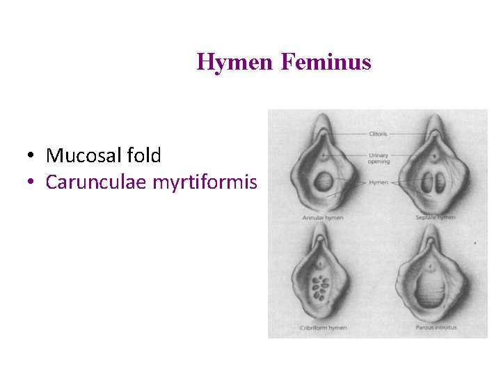 Hymen Feminus • Mucosal fold • Carunculae myrtiformis 