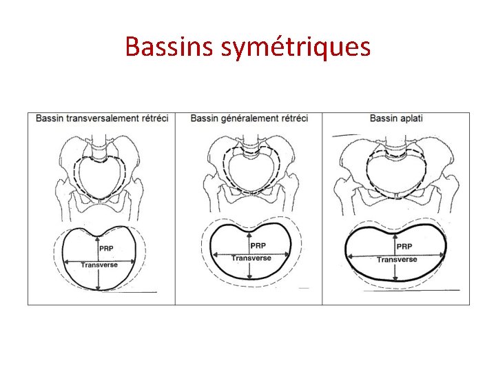 Bassins symétriques 