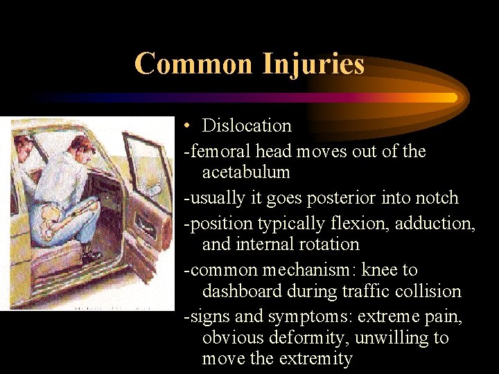 Common Injuries • Dislocation -femoral head moves out of the acetabulum -usually it goes