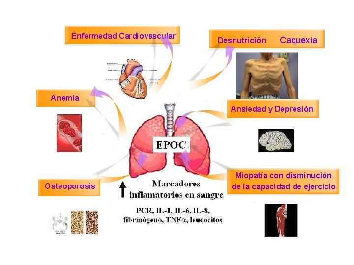 Enfermedad Cardiovascular Desnutrición Caquexia Anemia Ansiedad y Depresión Osteoporosis Miopatía con disminución de la